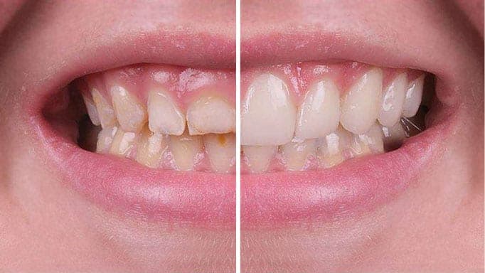 Diş Eti Estetiği (Gingival Estetik)