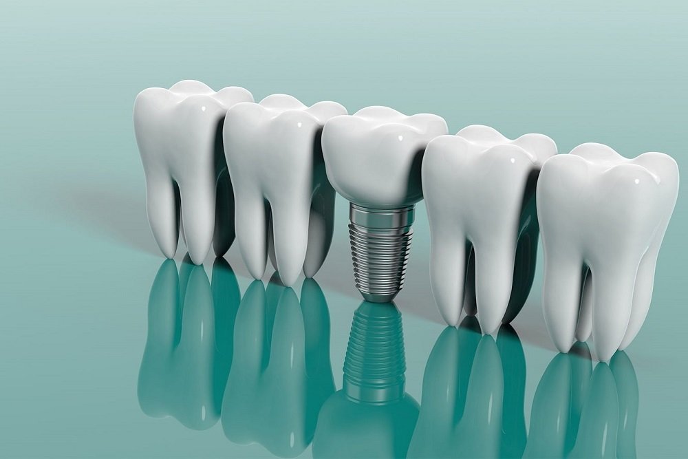 Dental İmplant